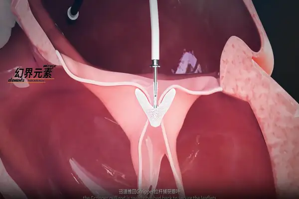 医疗手术动画